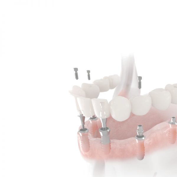 Протезирование зубов. Хорошая стоматология